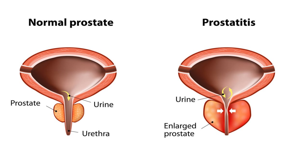 Erectile Dysfunction and Your Prostate 